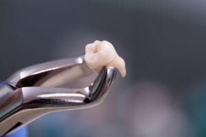 The Wisdom Of Wisdom Tooth Extraction