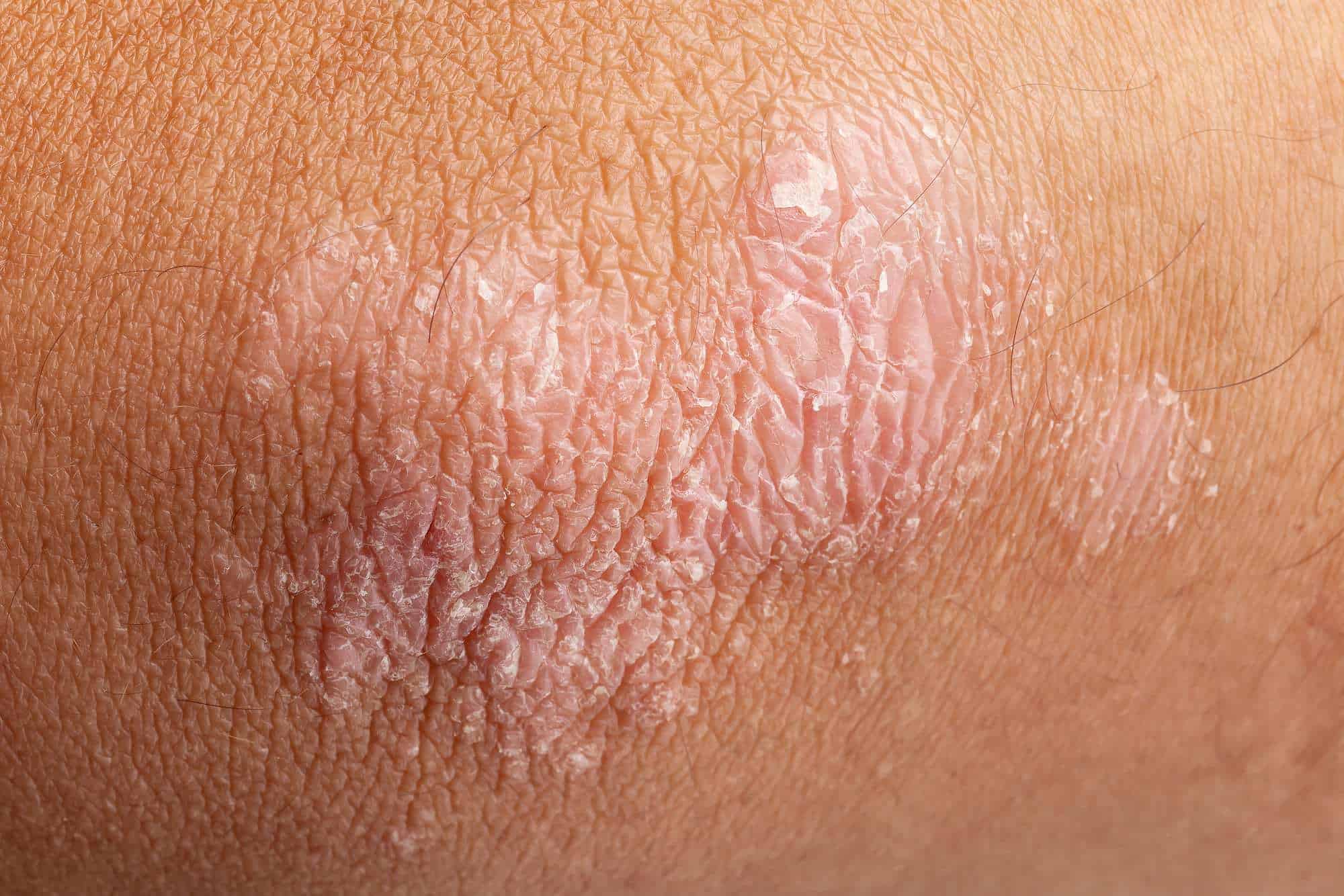 Changing The Way We Treat Psoriasis By Acknowledging Multiple Causes